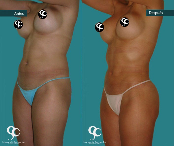 Testimonio lipolisis vaser Bogota